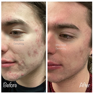 Acne Treatment Guide: Causes, Solutions, and Expert Care in Columbia, MD