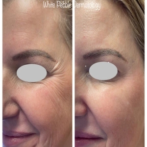 Botox, Jeuveau, Dysport, Dexxify, or Xeomin? Which is the Right Neuromodulator for my wrinkles?