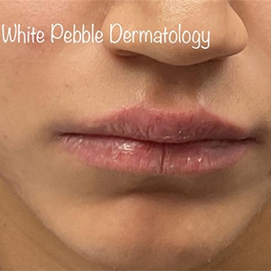 How to heal dry and chapped lips from your trusted dermatology in Columbia MD