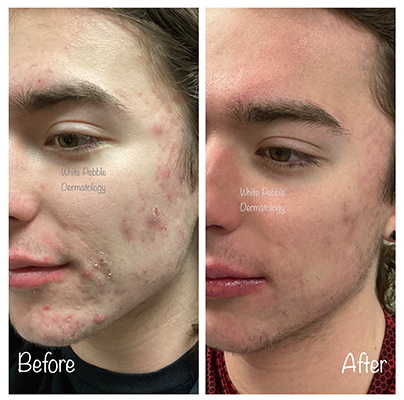 Acne Treatment Guide: